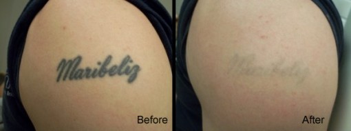 Over Half Off Laser Tattoo Removal at Rethink the Ink Over Half Off Laser Tattoo Removal at Rethink the Ink